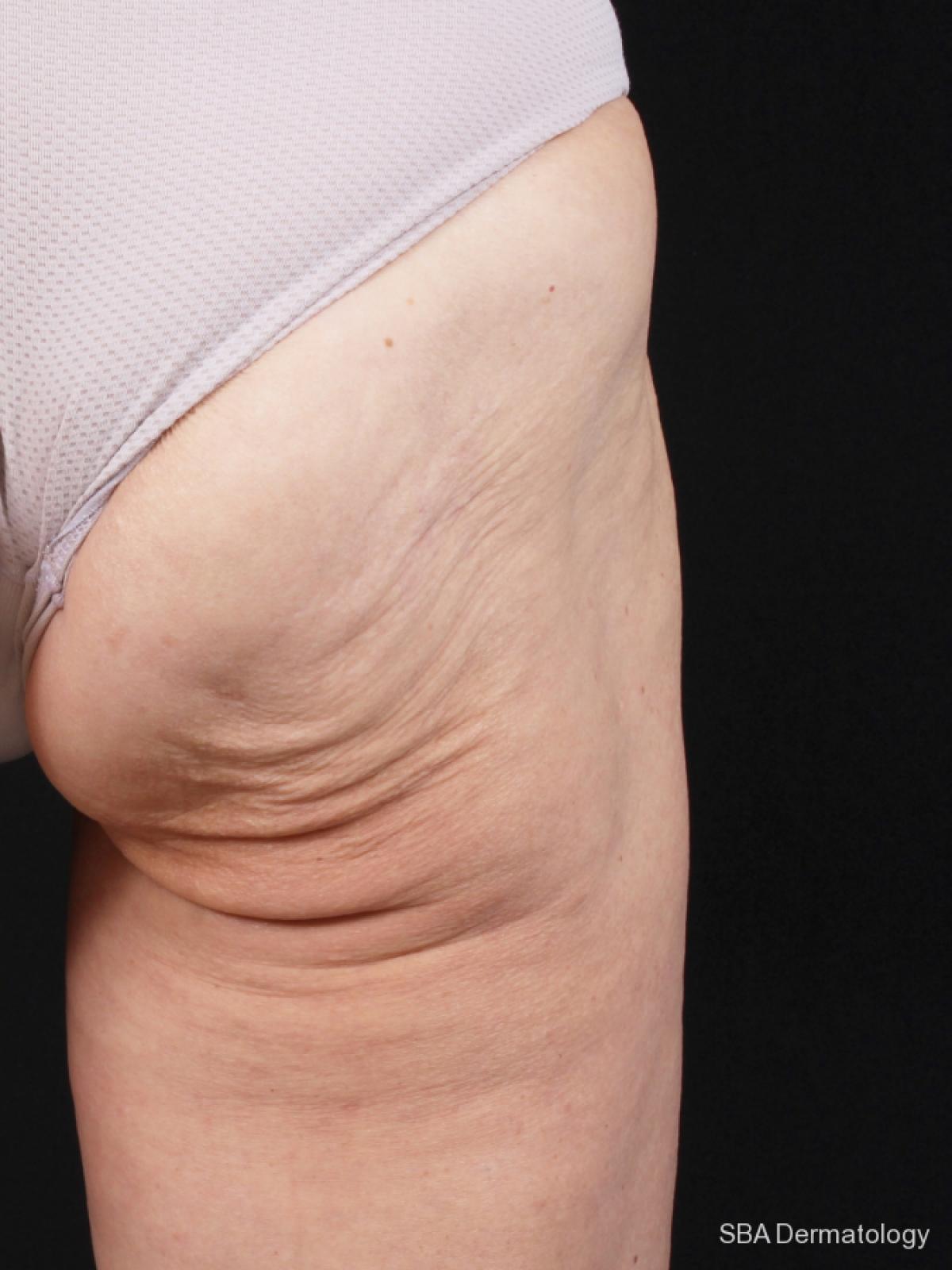 Sculptra-Body: Patient 1 - Before 1