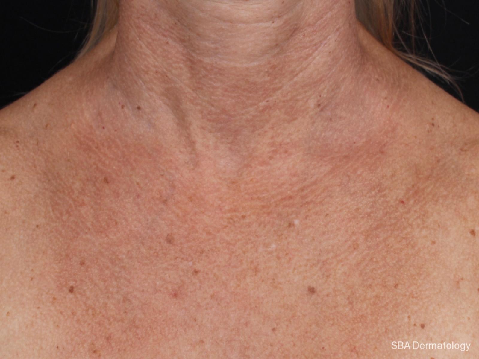 IPL-Photofacial: Patient 4 - Before 