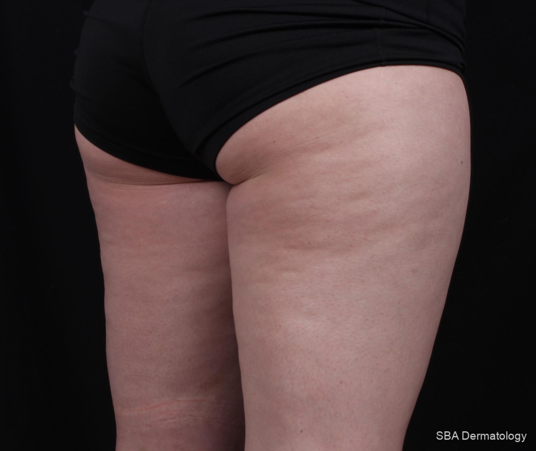 Velashape: Patient 5 - Before 