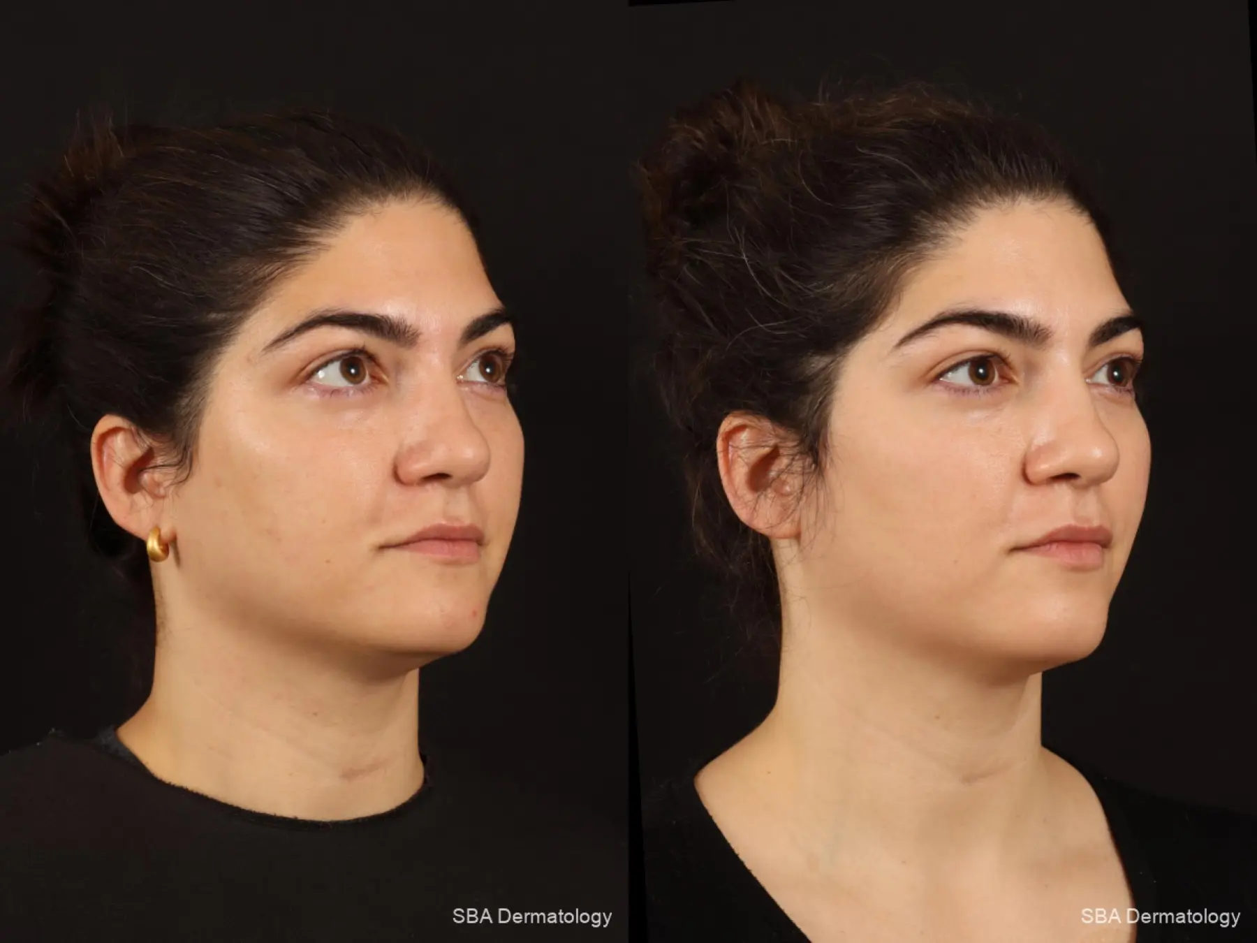 Chemical Peels: Patient 3 - Before and After 2