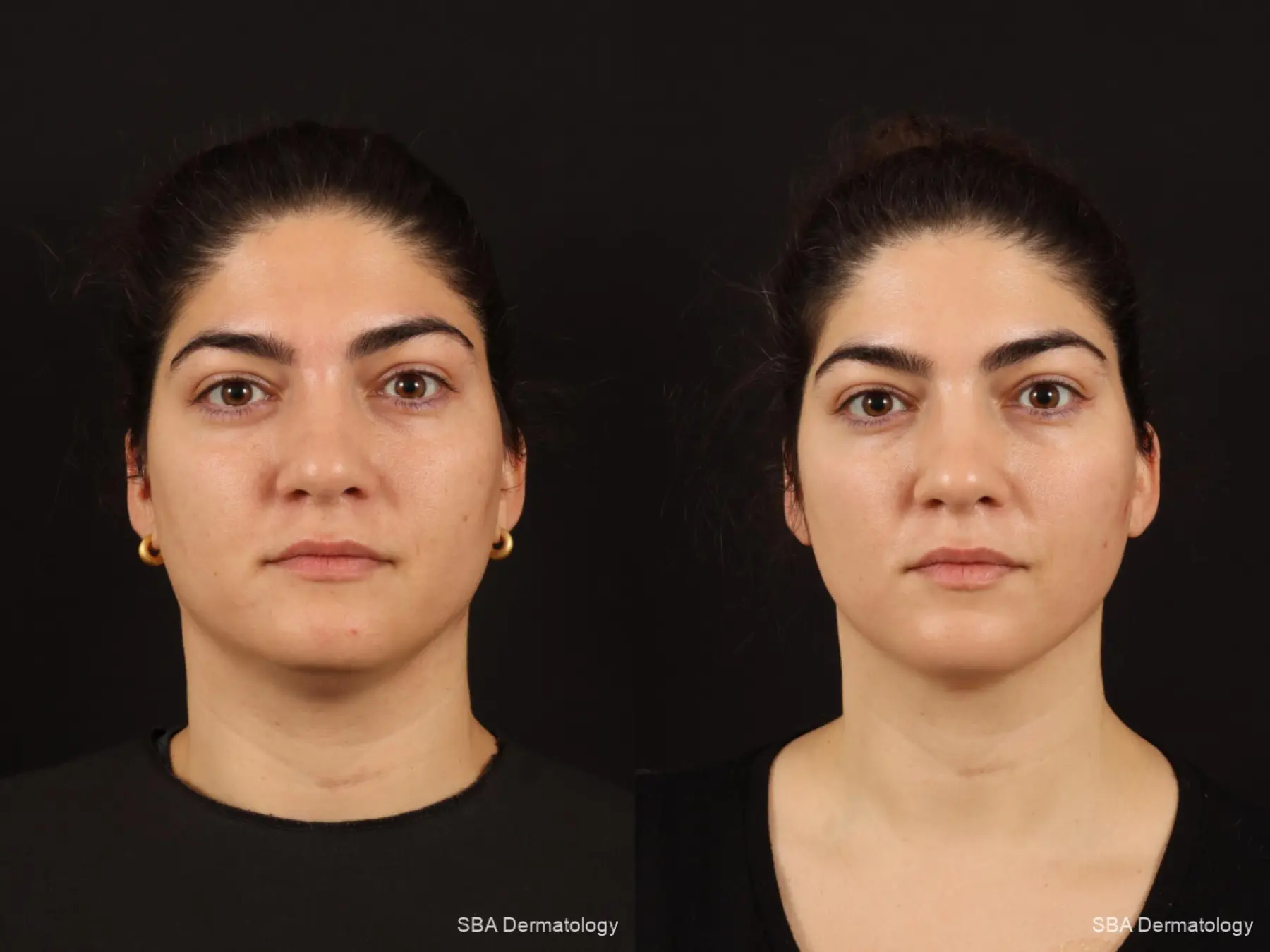 Chemical Peels: Patient 3 - Before and After  