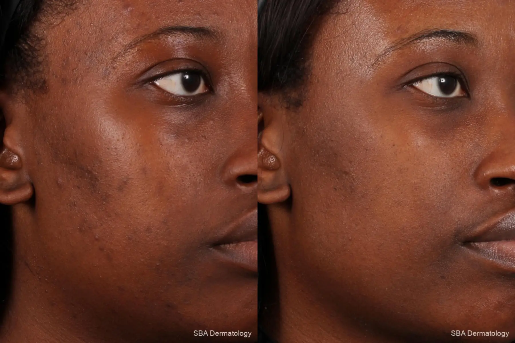 Chemical Peels: Patient 2 - Before and After 5