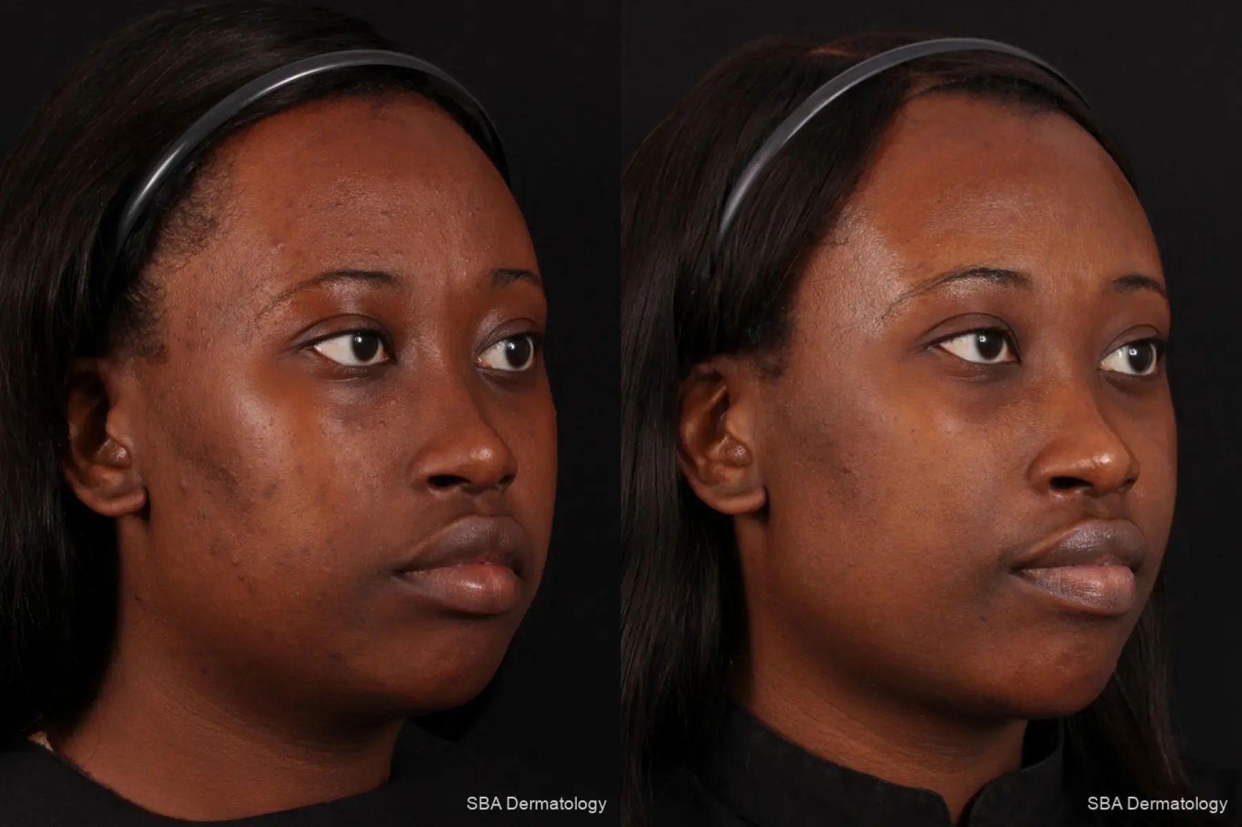 Chemical Peels: Patient 2 - Before and After 3