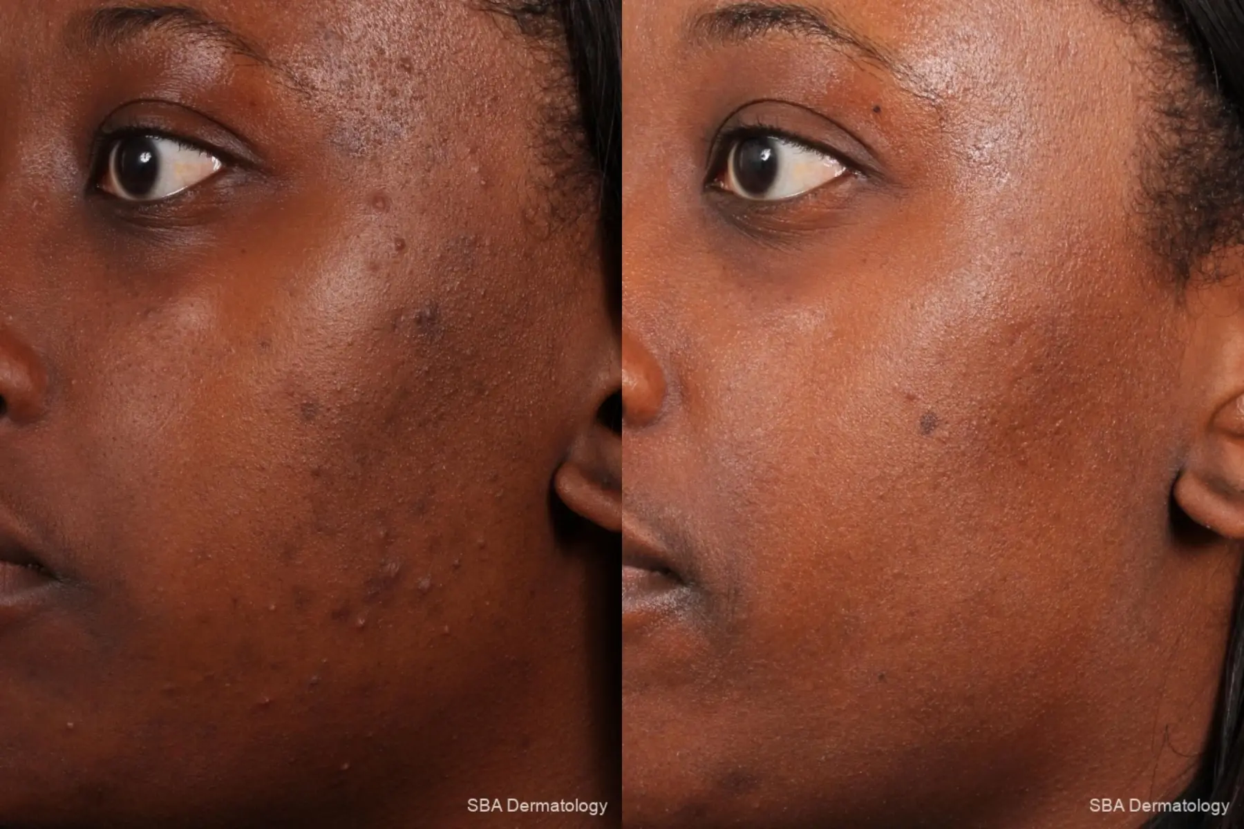 Chemical Peels: Patient 2 - Before and After 4