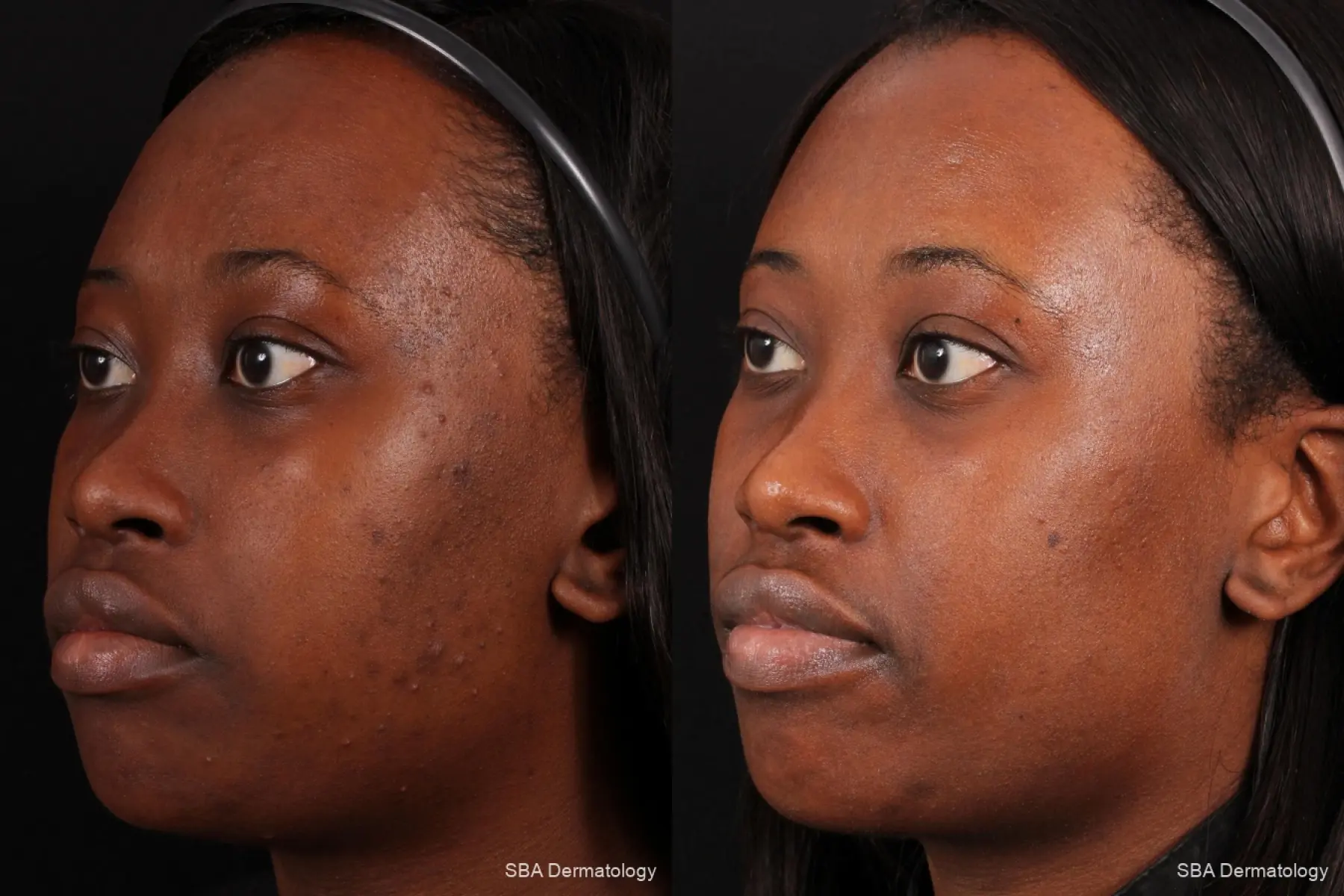 Chemical Peels: Patient 2 - Before and After 1