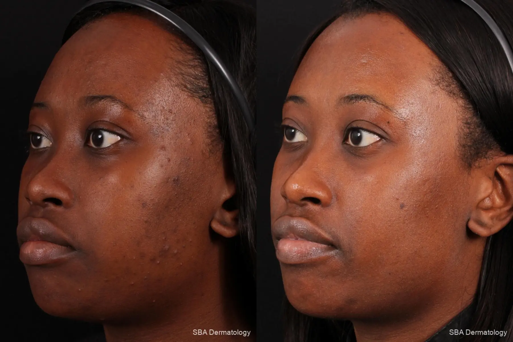 Chemical Peel Before & After