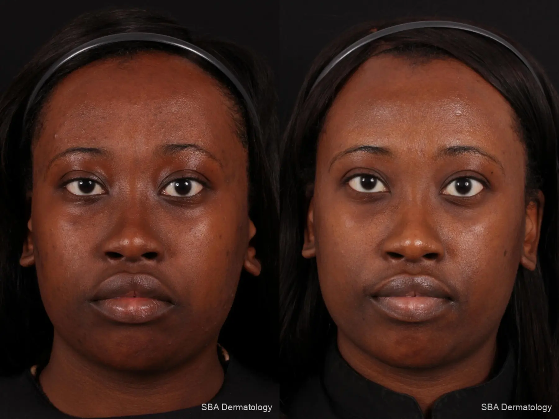 Chemical Peels: Patient 2 - Before and After 2