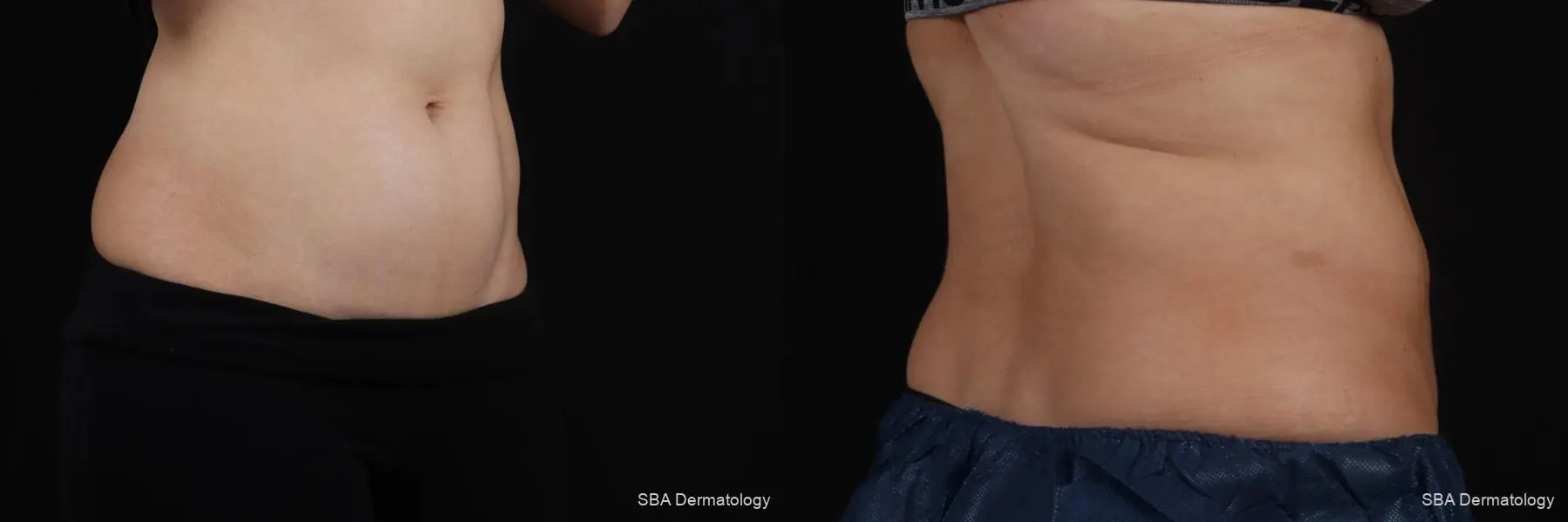 Coolsculpting: Patient 6 - Before and After 6