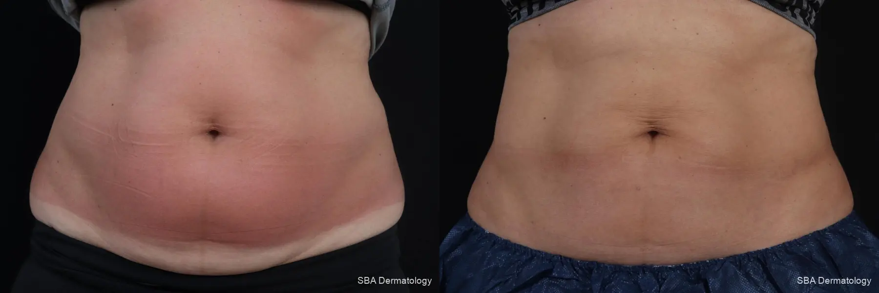 Coolsculpting: Patient 6 - Before and After 1