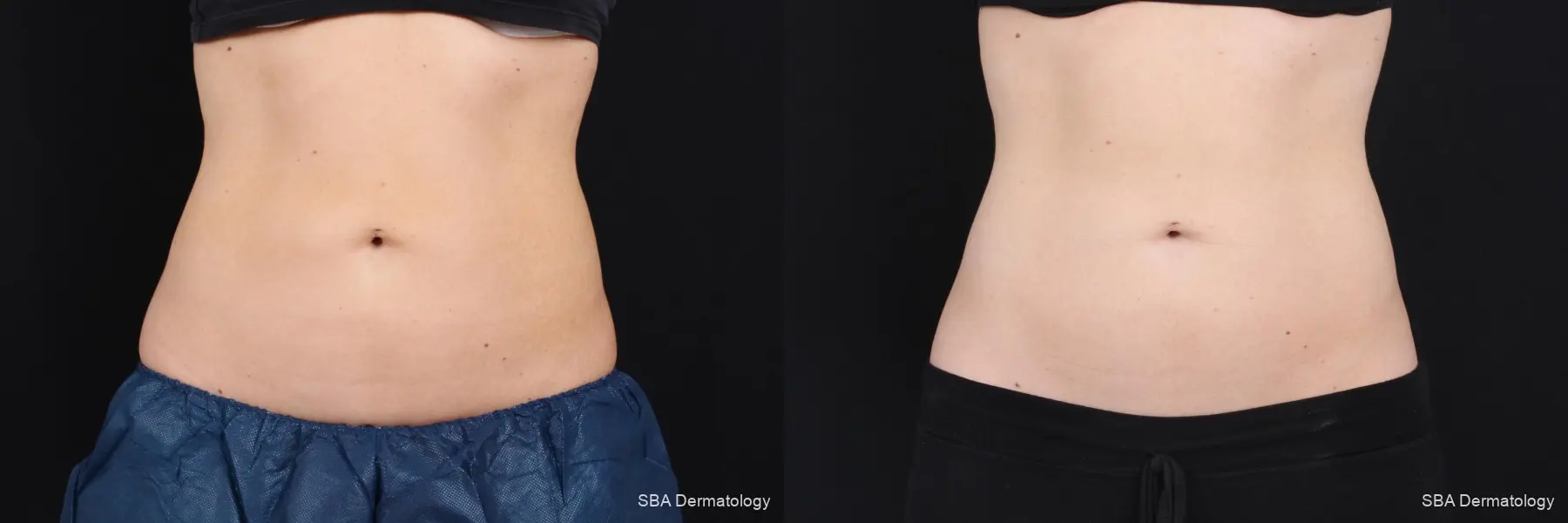Coolsculpting: Patient 7 - Before and After 1