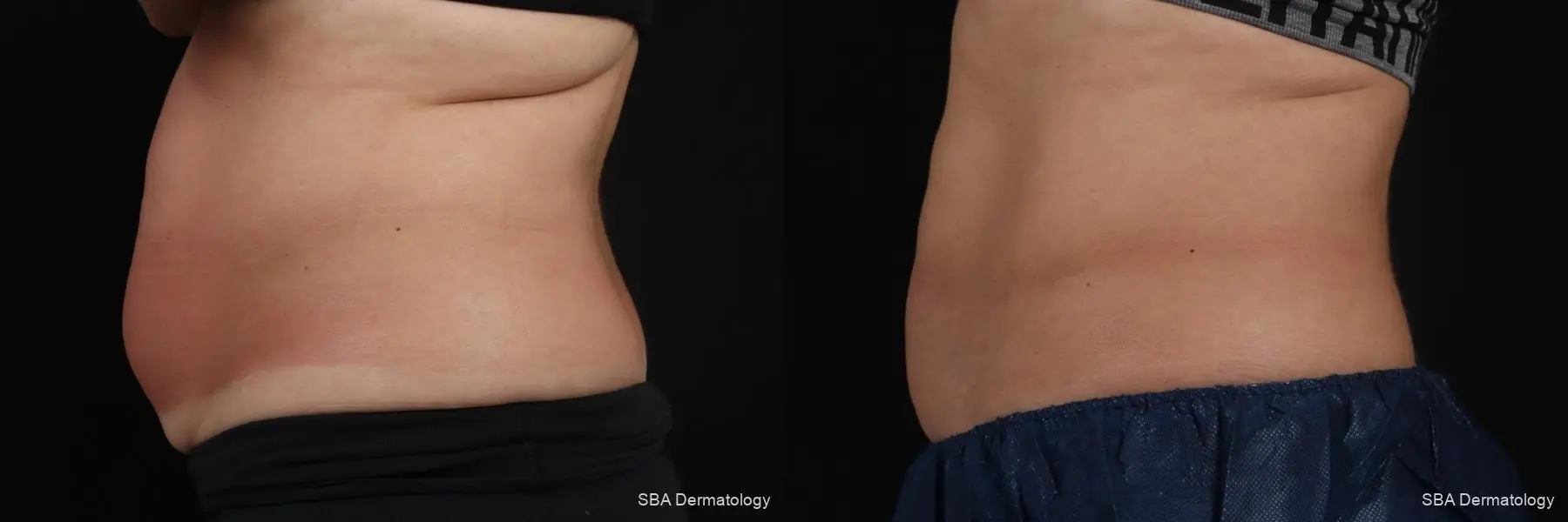 Coolsculpting: Patient 6 - Before and After 3
