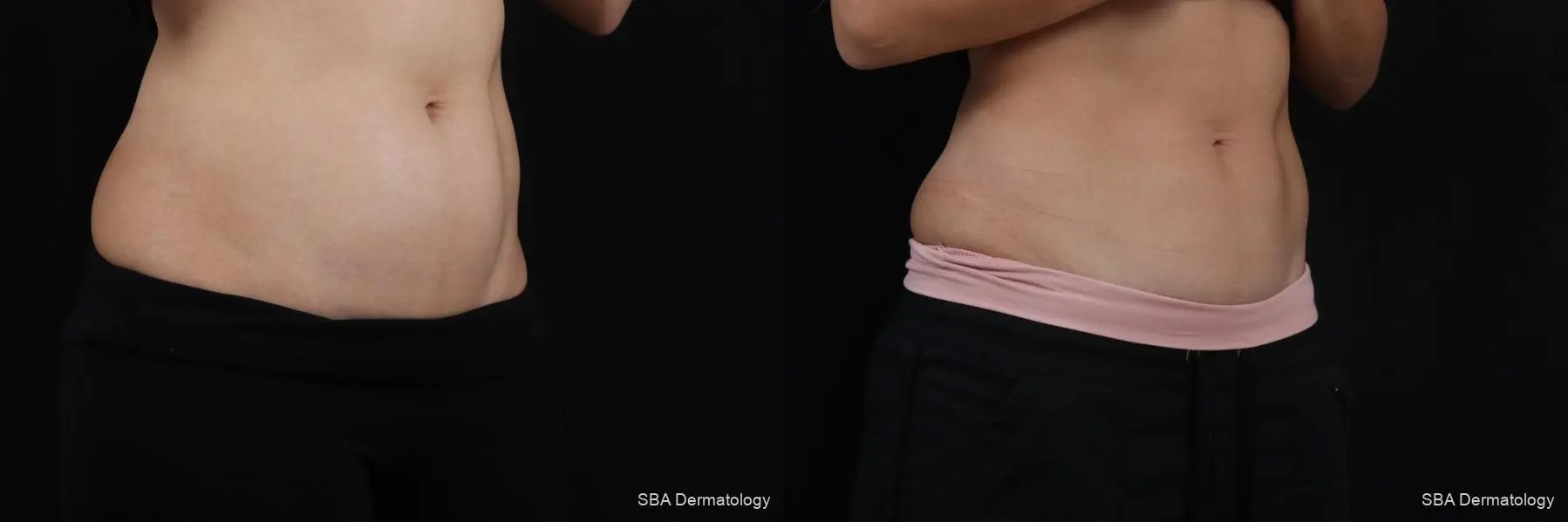 Coolsculpting: Patient 8 - Before and After 6