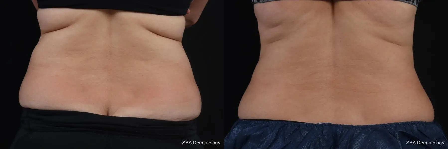 Coolsculpting: Patient 6 - Before and After 5