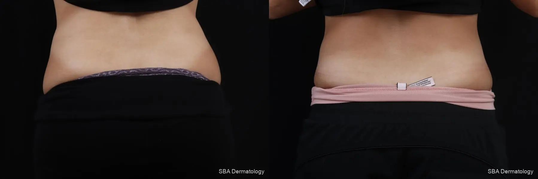 Coolsculpting: Patient 8 - Before and After 5