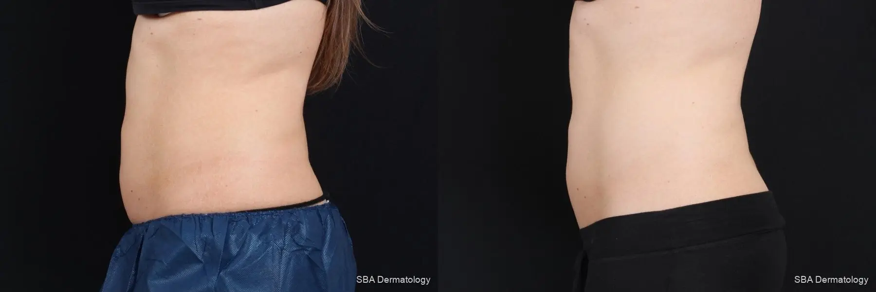 Coolsculpting: Patient 7 - Before and After 3