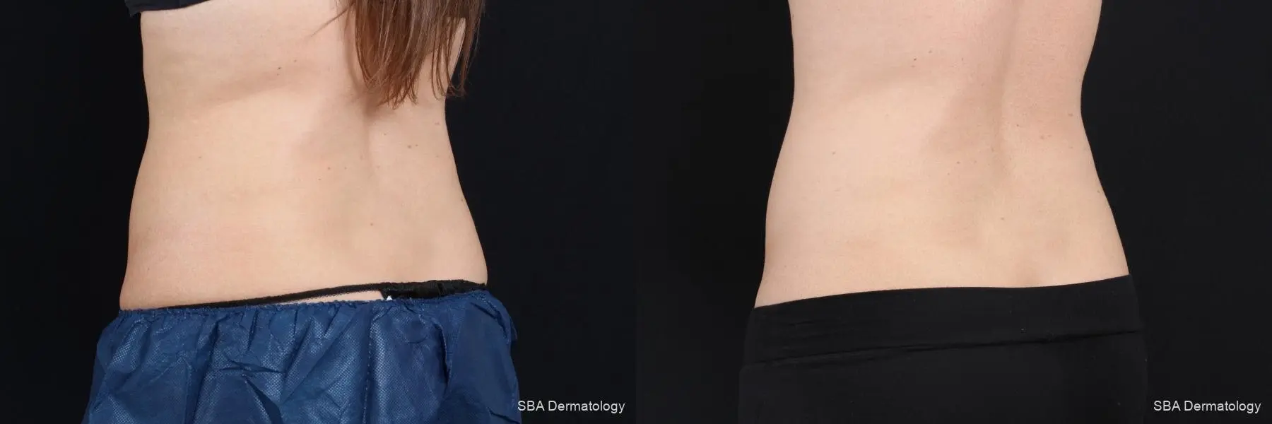 Coolsculpting: Patient 7 - Before and After 4