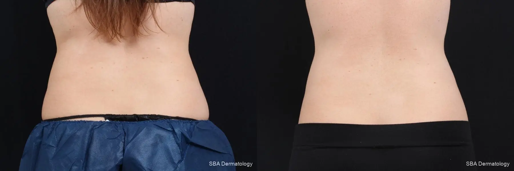 Coolsculpting: Patient 7 - Before and After 5