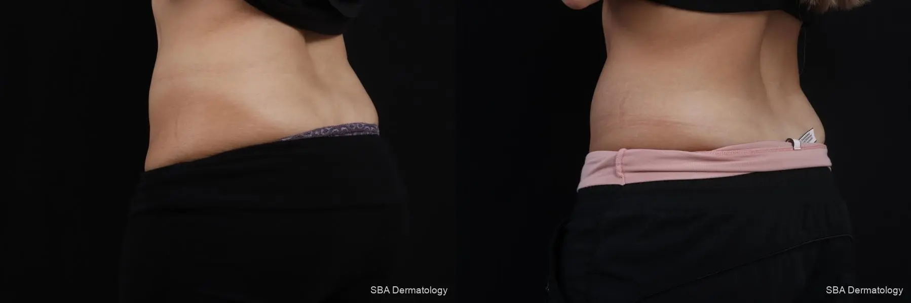 Coolsculpting: Patient 8 - Before and After 4