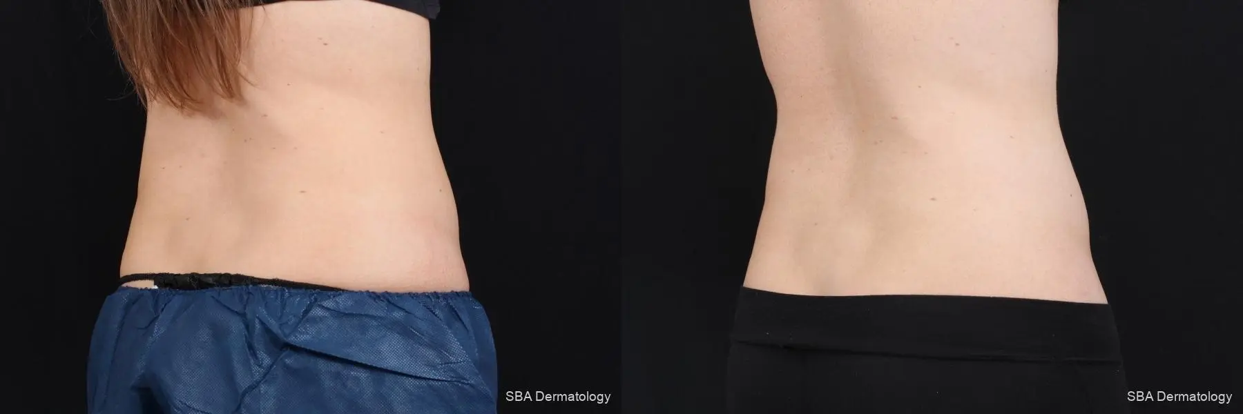 Coolsculpting: Patient 7 - Before and After 6