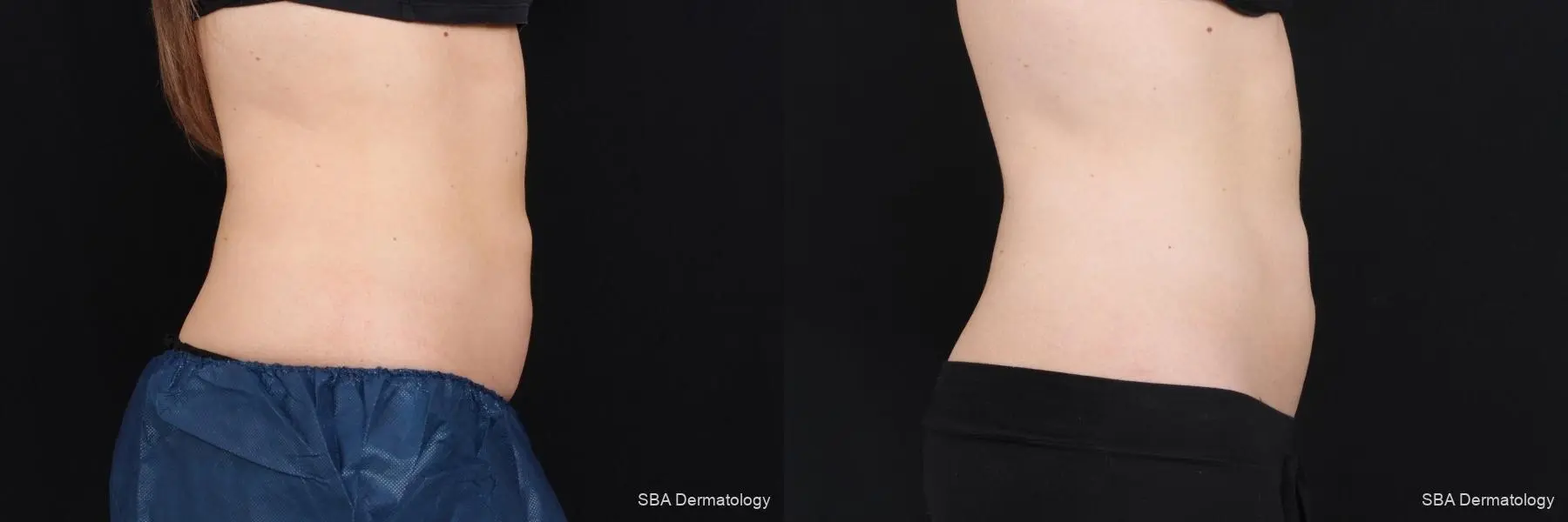 Coolsculpting: Patient 7 - Before and After 7