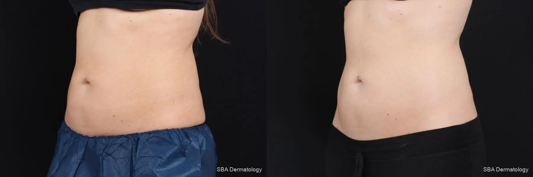 Coolsculpting: Patient 7 - Before and After 2