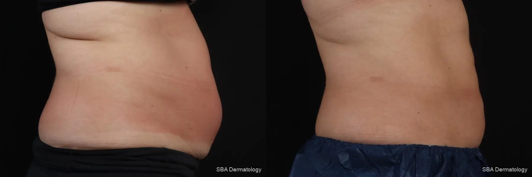 Coolsculpting: Patient 6 - Before and After 7