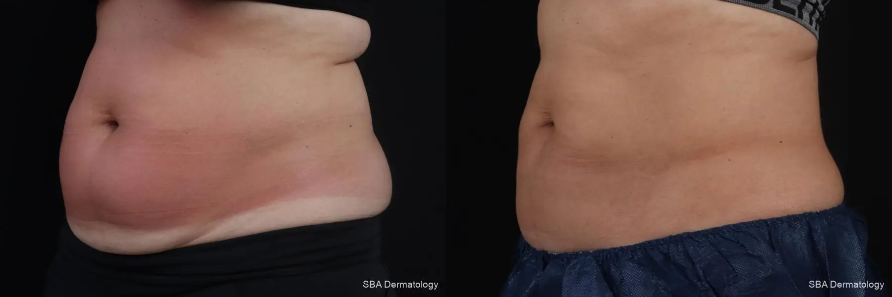 Coolsculpting: Patient 6 - Before and After 2