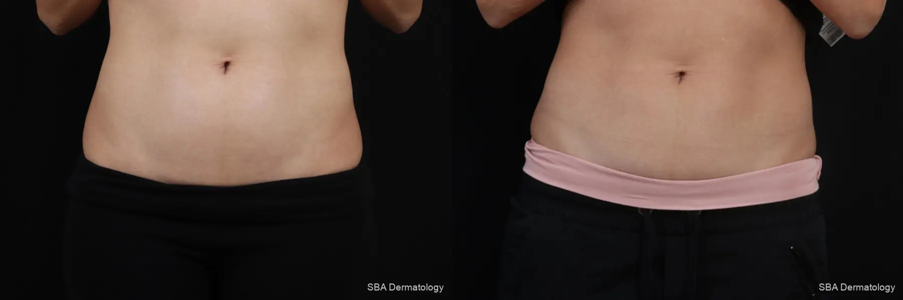 Coolsculpting: Patient 8 - Before and After 1