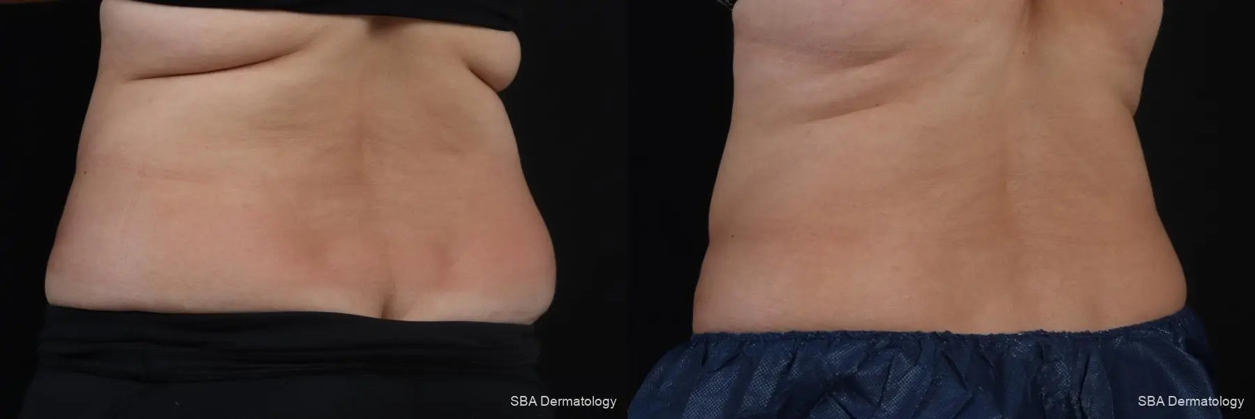 Coolsculpting: Patient 6 - Before and After 4