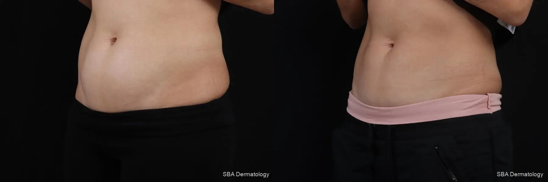 Coolsculpting: Patient 8 - Before and After 2