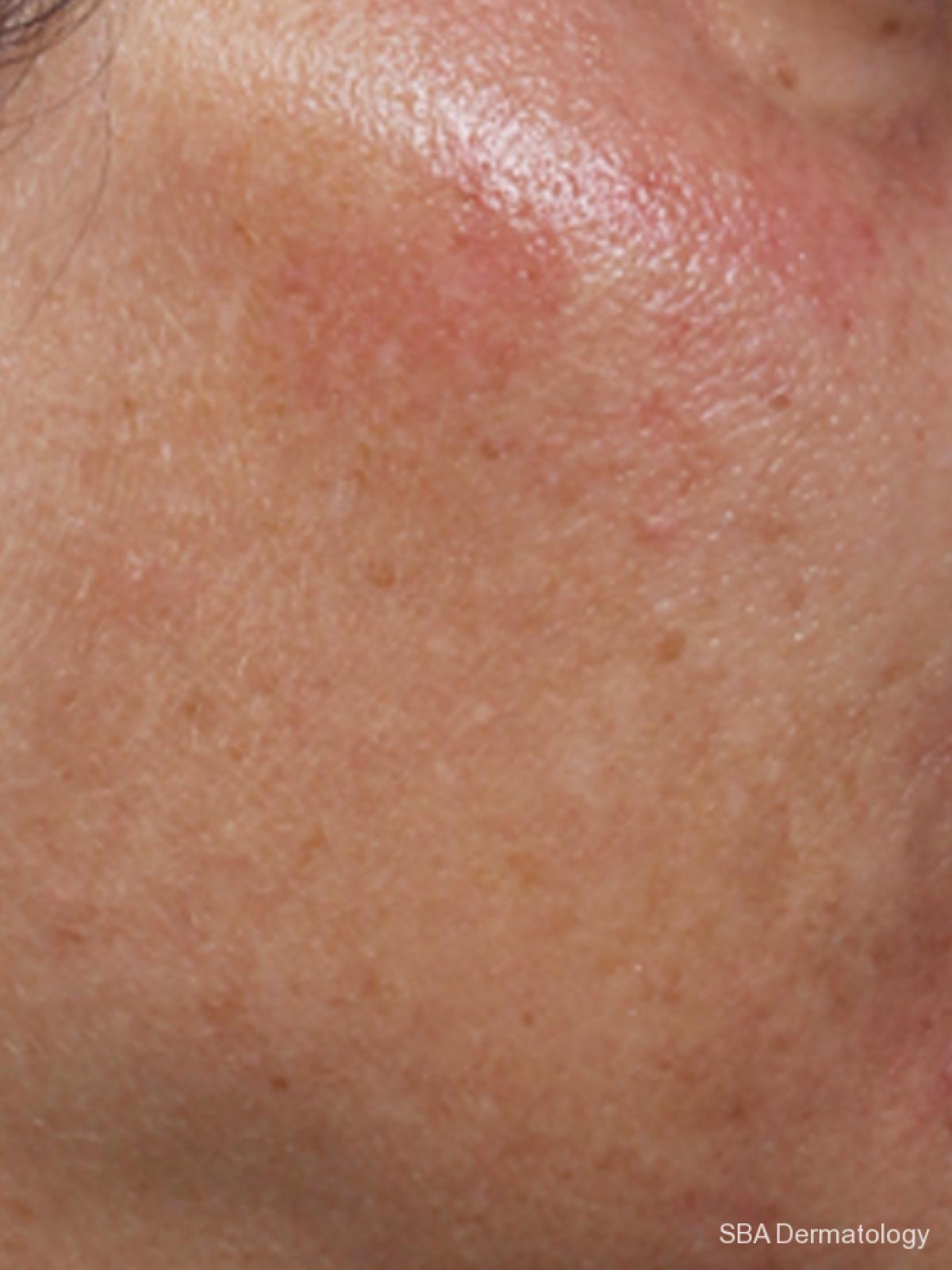 Microneedling: Patient 1 - Before 