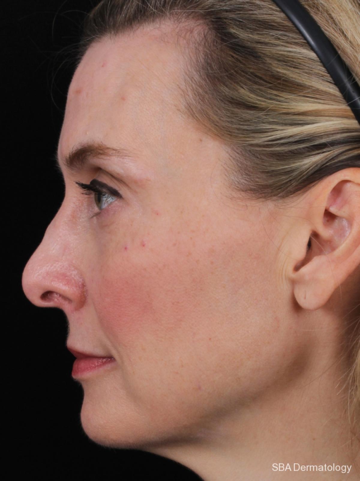 Sculptra-Face: Patient 1 - After  