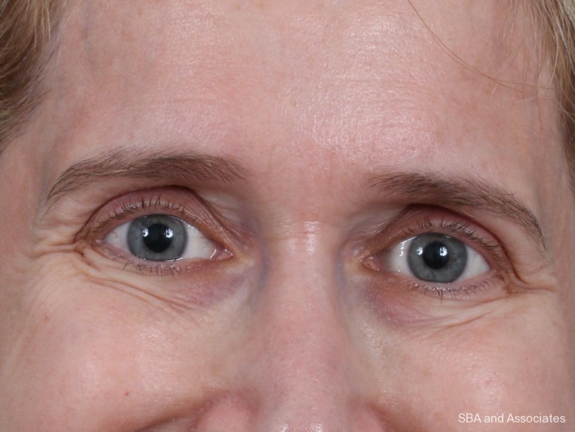 Botox: Patient 6 - Before 4