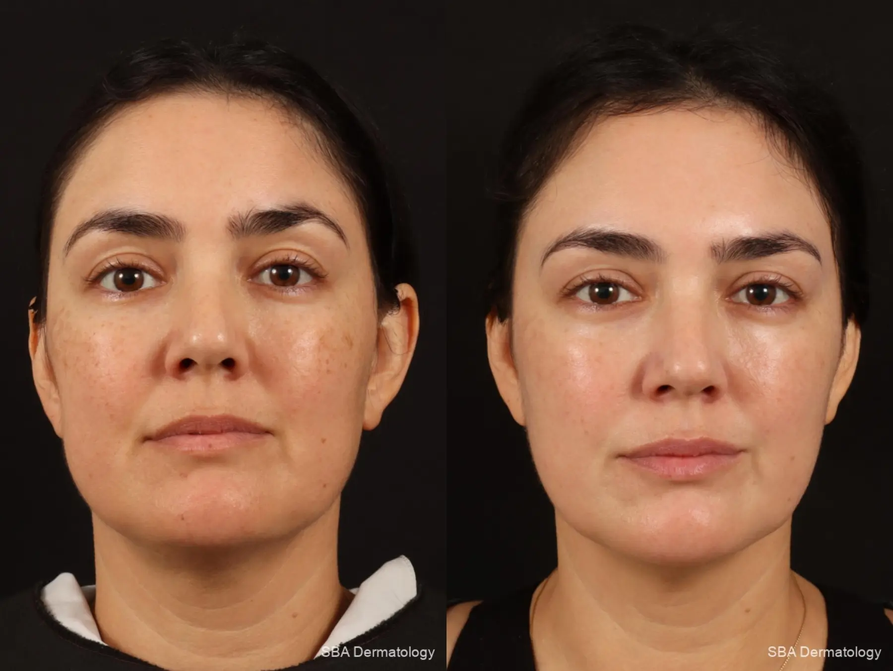 IPL-Photofacial: Patient 7 - Before and After 1