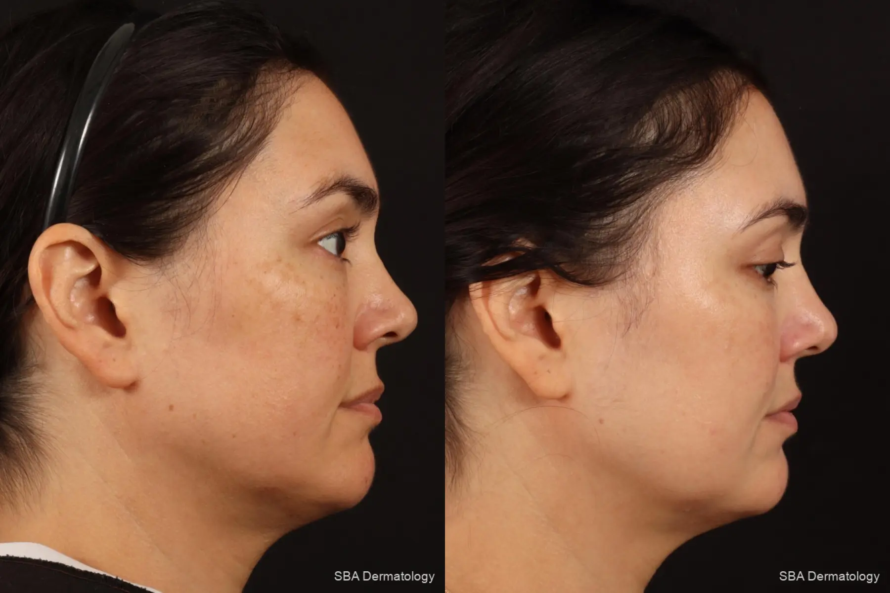 IPL-Photofacial: Patient 7 - Before and After 3