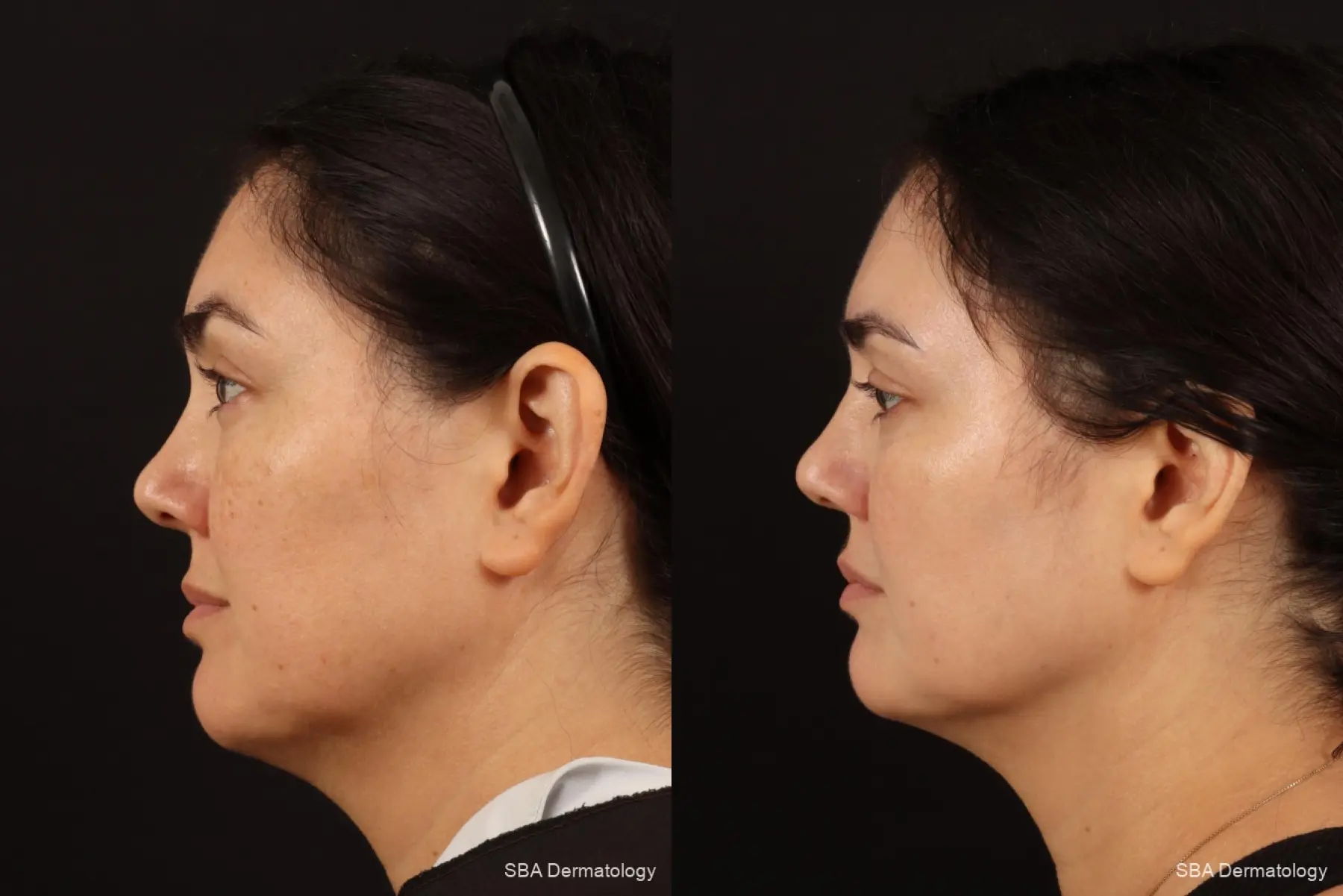 IPL-Photofacial: Patient 7 - Before and After 2