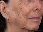 IPL-Photofacial: Patient 1 - Before 