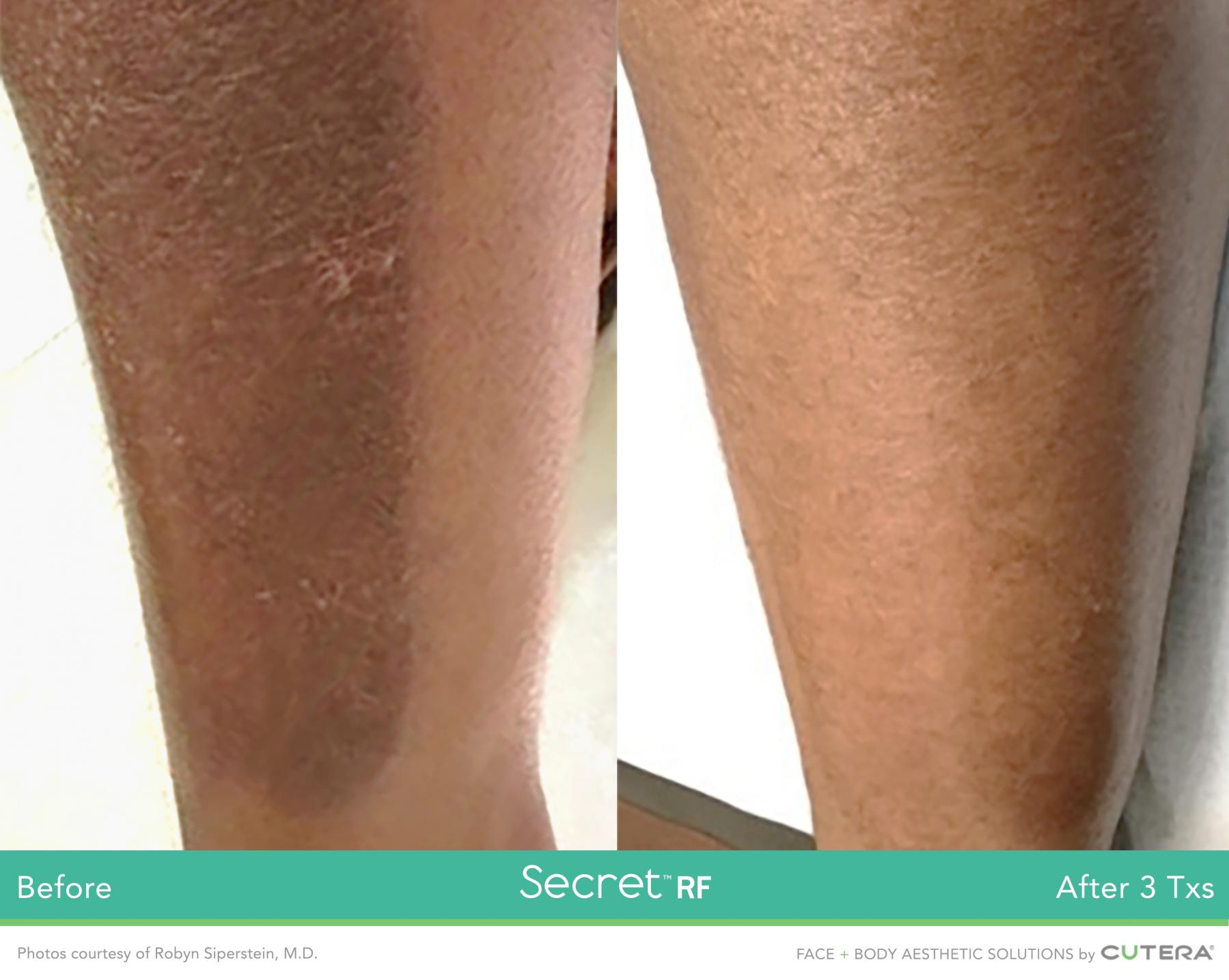 Secret RF: Patient 22 - Before and After 1