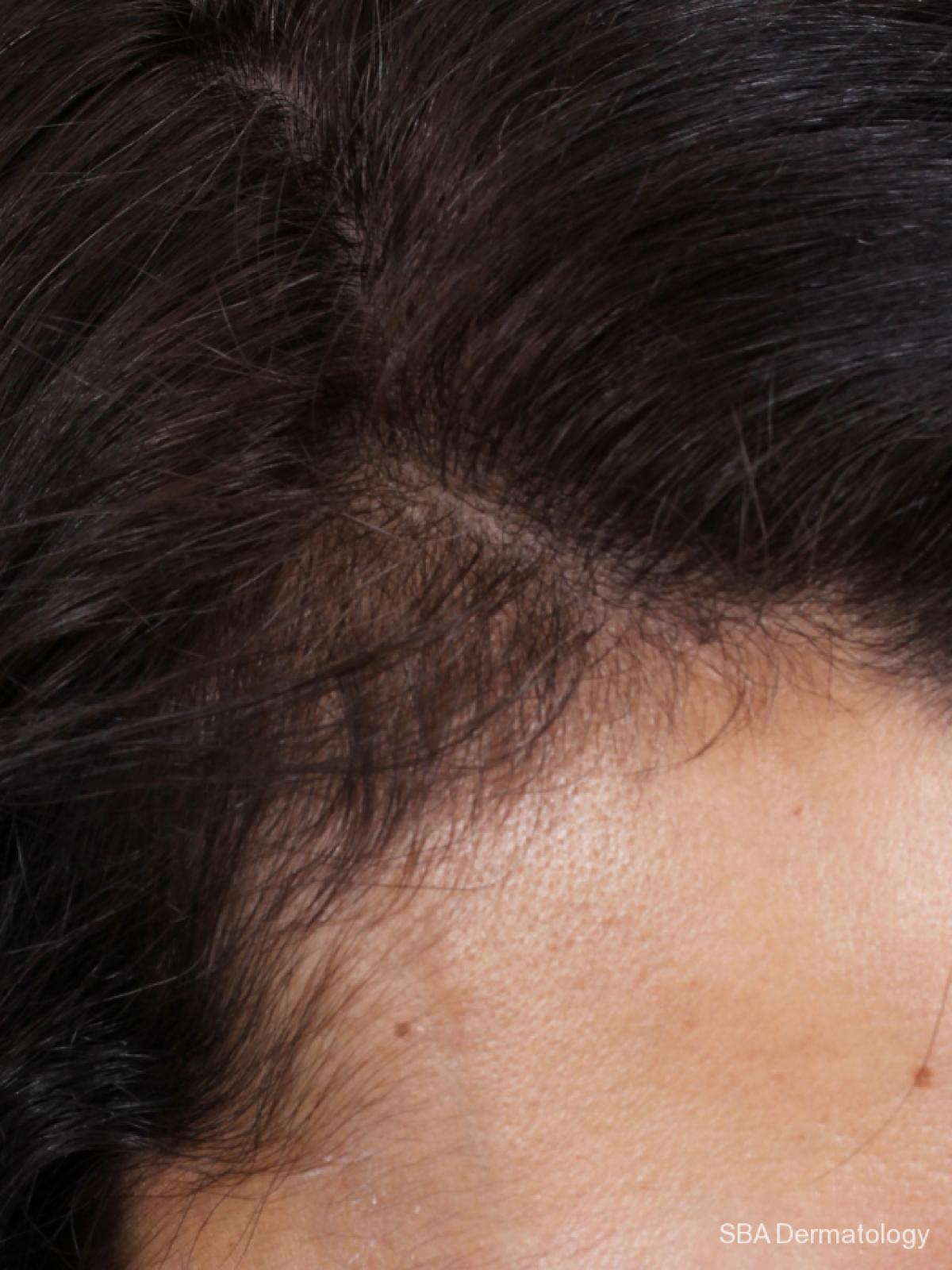 PRP For Hair Loss: Patient 1 - Before 1
