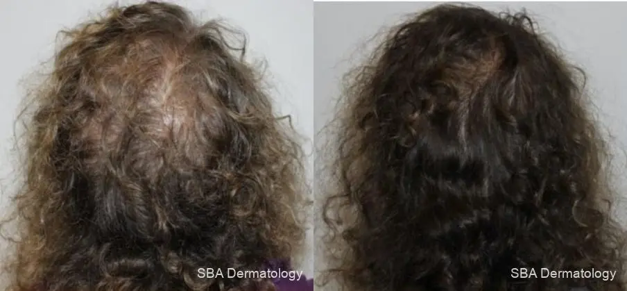 Keravive: Patient 4 - Before and After 1