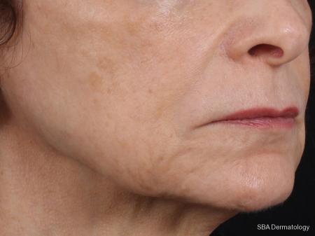 Photofractional: Patient 1 - After 1