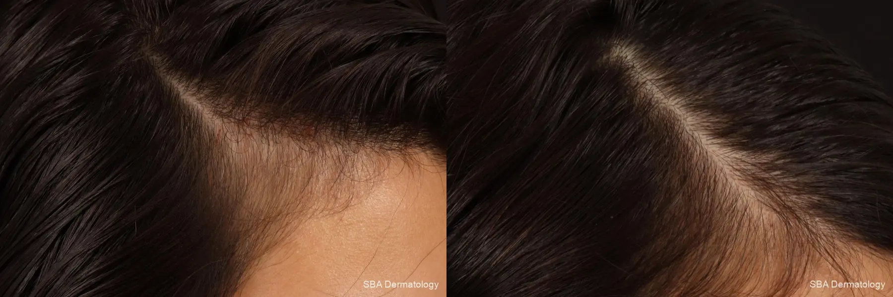 PRP For Hair Loss: Patient 4 - Before and After 1