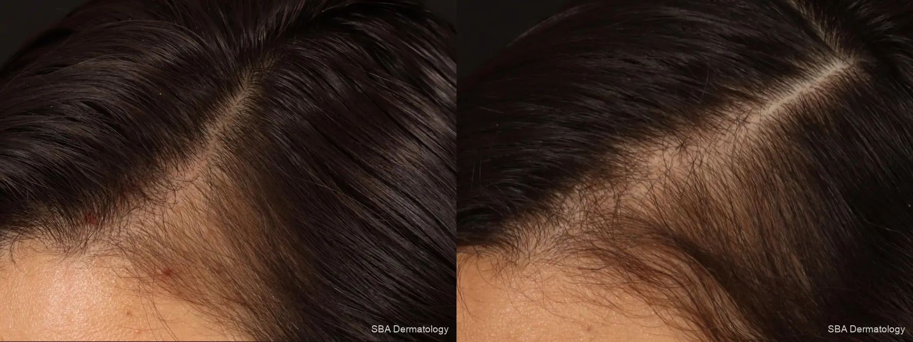 PRP For Hair Loss: Patient 4 - Before and After 2