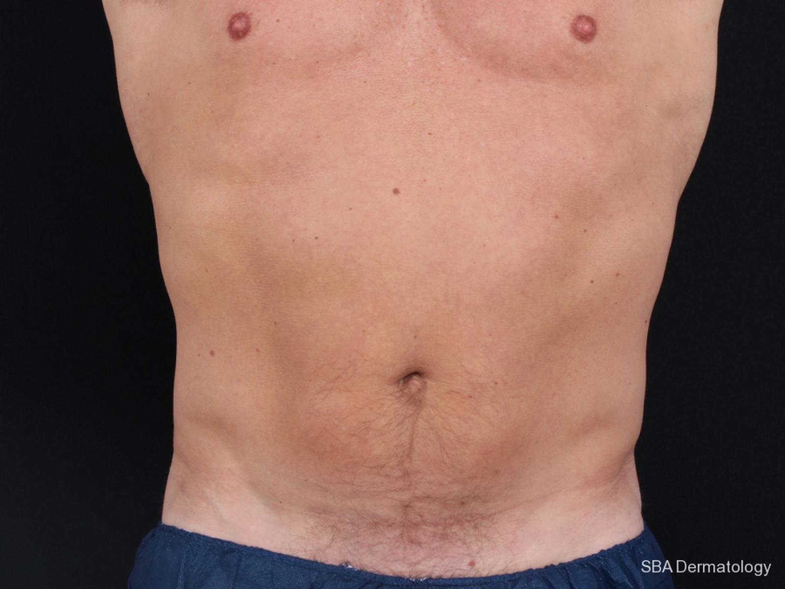 Coolsculpting: Patient 3 - After 1