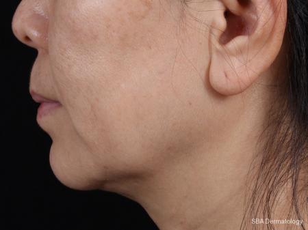 Kybella- Face: Patient 3 - After  