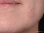 IPL-Photofacial: Patient 3 - After 