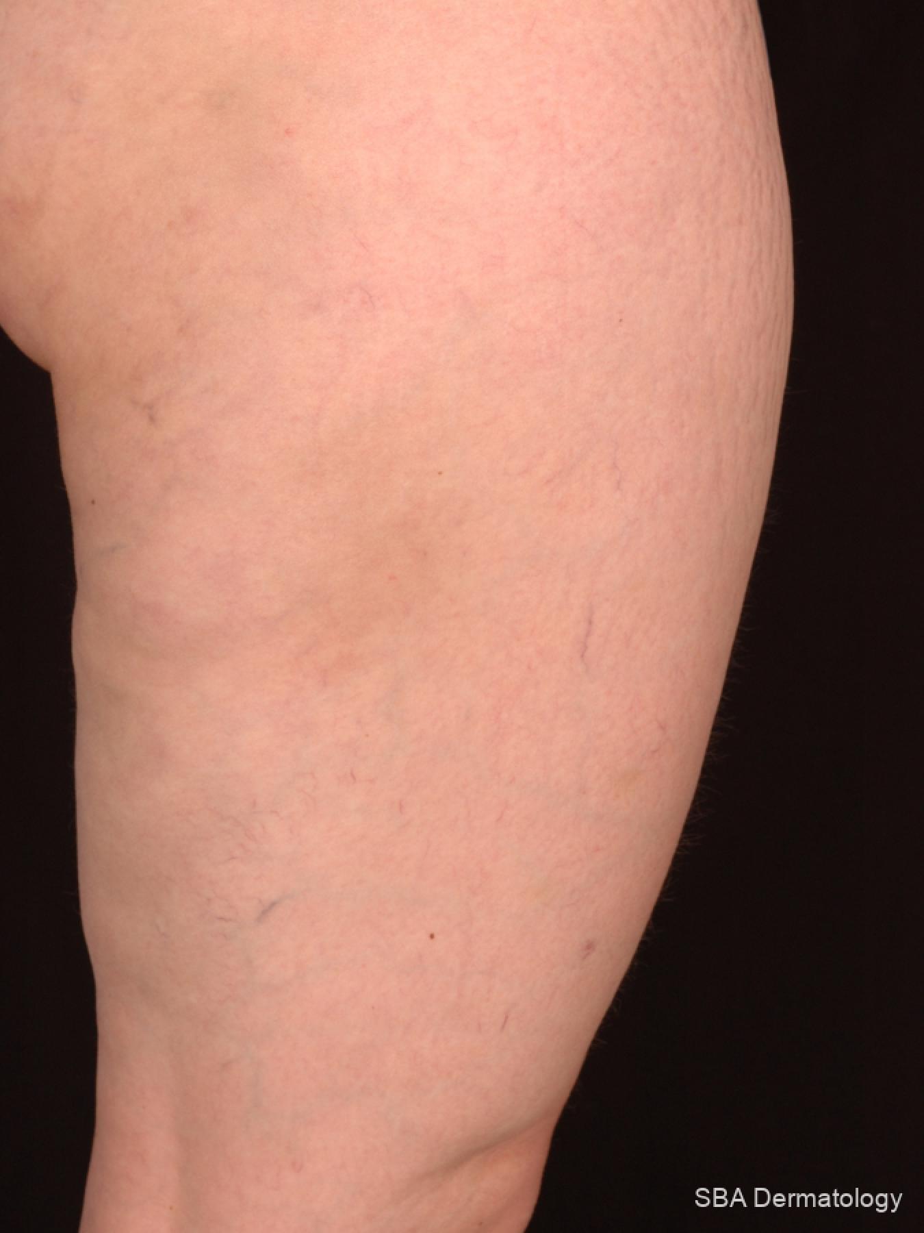 Velashape: Patient 3 - After  