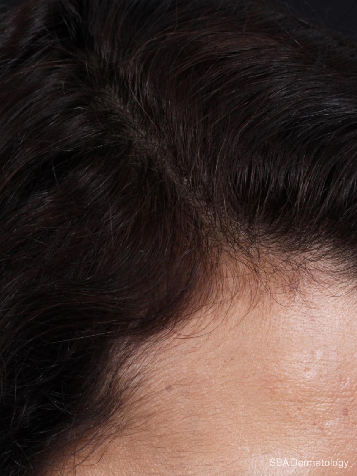 PRP For Hair Loss: Patient 1 - After 1