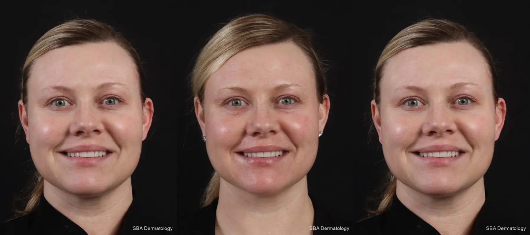 Secret RF: Patient 32 - Before and After 2
