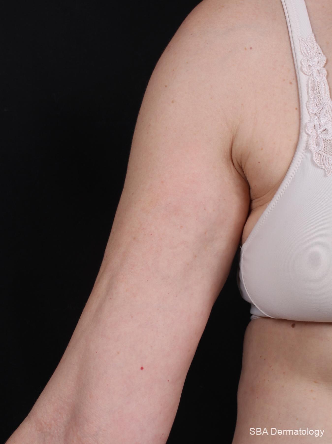 Velashape: Patient 1 - After 1